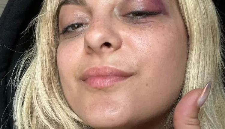 اعترافات جديدة في قضية إصابة بيبي ريكسا على المسرح