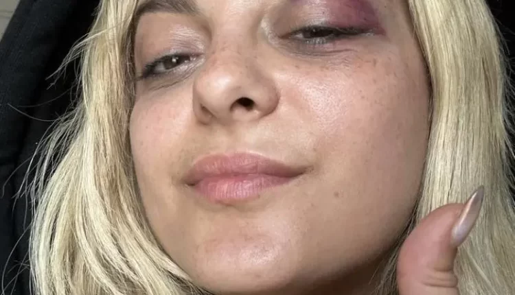 بيبي ريكسا تتعرض لإصابة بالموبايل من أحد المعجبين خلال حفلها